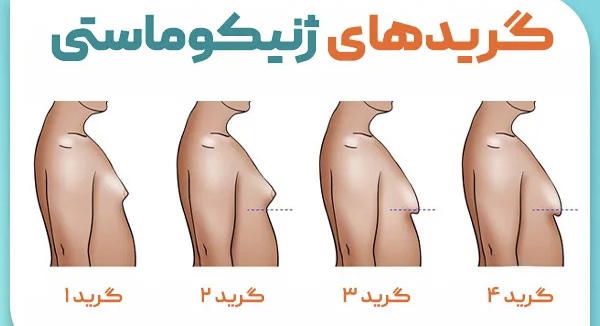 ژنیکوماستی